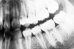 x-ray